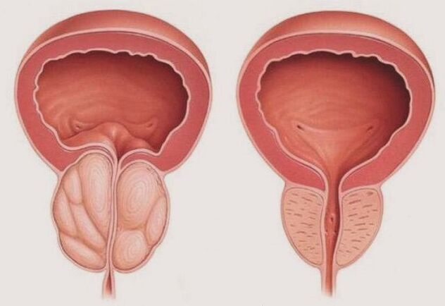 prostata sana e infiammata con prostatite