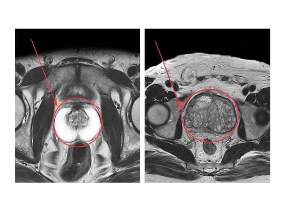 Confronto tra una prostata sana (a sinistra) e una infiammata (a destra) sulle immagini MRI
